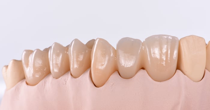 Bridge zircone sur implant : Esthétique blanche et rose