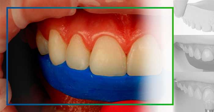 Caso Clínico - Estratificação com Resinas Compostas nas Restaurações de Dentes Anteriores - Dra. Aline Santade