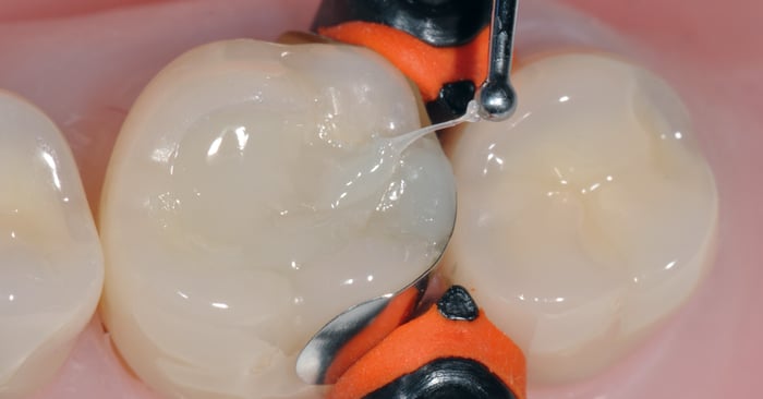 Indications and protocols for direct restorations