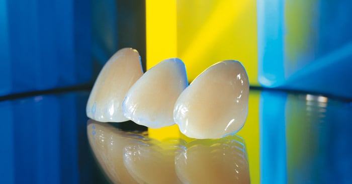 La céramo métal : d’une dent simple vers une dent plus élaborée