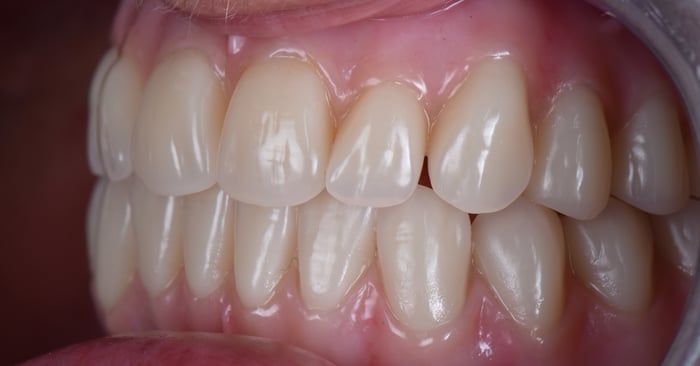 Three concepts for successful high-quality complete dentures