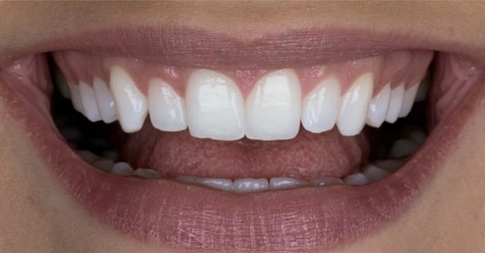 Moderne Methoden der Zahnaufhellung – sicher und effektiv