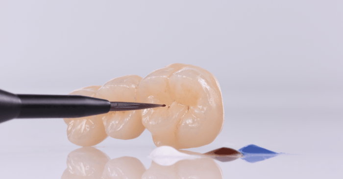 The 3D Color Integration in Monolithic Restorations