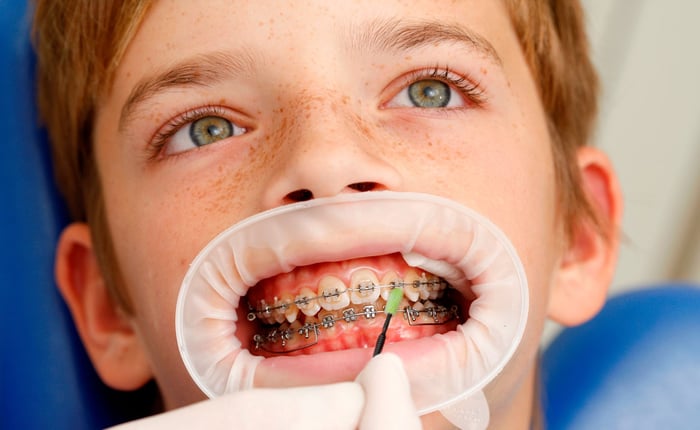 How to supply orthodontic patients with fluoride?