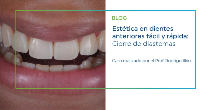 Estética en dientes anteriores fácil y rápida: Cierre de diastemas