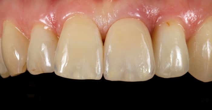 Tips from an expert: How to produce highly esthetic restorations by using the cut-back technique