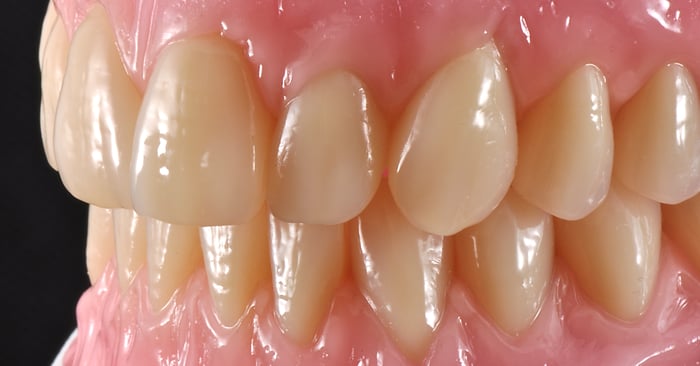 Total dentures with great esthetics