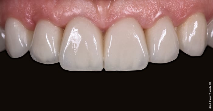 Dental restorations: Colour isn't the only thing responsible for a beautiful appearance