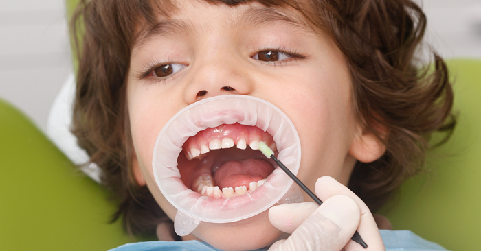 Controlled protection for milk teeth with Fluoride Varnish