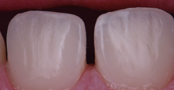 Esthetic Camouflage and Correction of Trauma-Involved Incisor Hypomineralization
