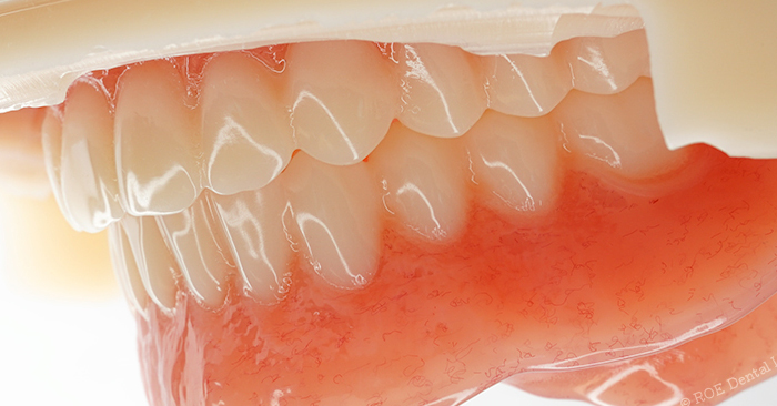 Peer-to-Peer Review from ROE Dental Laboratory: Ivotion Denture System