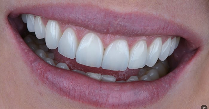 Caso clínico: Laminados cerâmicos reforçados por dissilicato de Lítio na estética e rearmonização do sorriso.