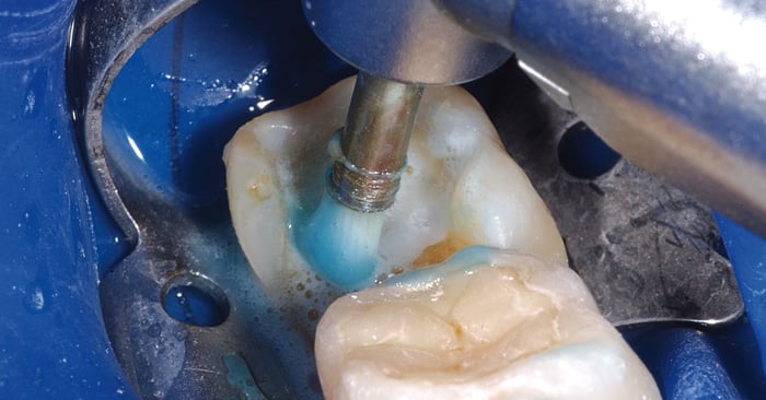 Practice tip: Here is how you effectively clean preparations and cavities before adhesive cementation