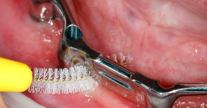 Wenn Zähneputzen nicht ausreicht: Intensive Mundpflege mit CHX