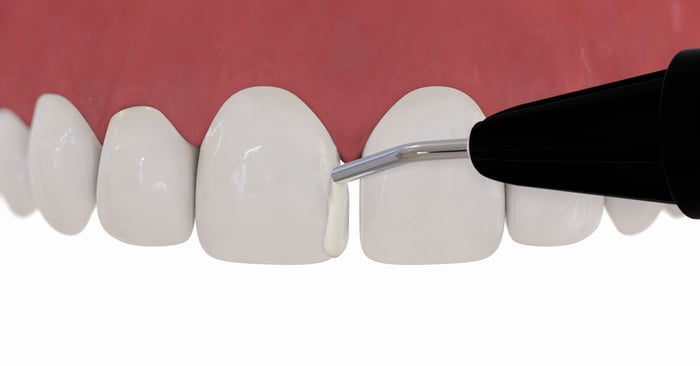 Practical tip: flowables come in handy in anterior teeth