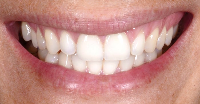 Trayless tooth whitening system: e.g. for bleaching teeth adjacent to veneers