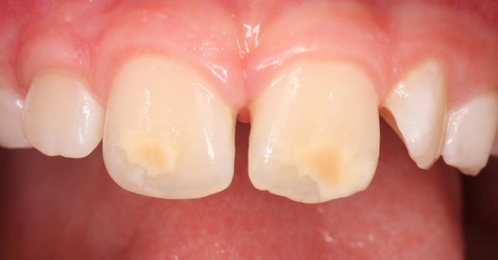 Interview: Molar Incisor Hypomineralization – a silent epidemic in children