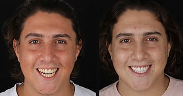 Caso Clínico - Reanatomização estética simplificada em incisivos laterais superiores - Dra. Alice Maria de Oliveira Dal Piva