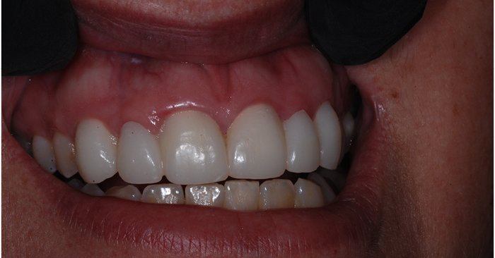 Healing Power: Cervitec Plus helps idealize gingival tissue health before and after treatment.
