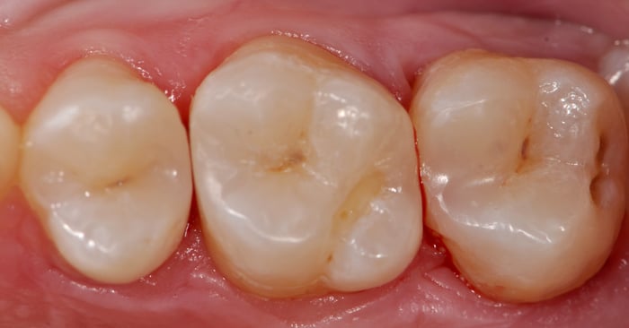 A Simple Approach to Direct Restoratives