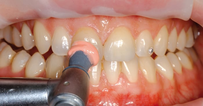 This is how you maintain the quality of all-ceramic restorations
