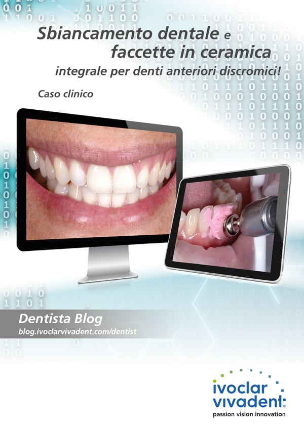 Bleaching con sistema di lacca e senza mascherina