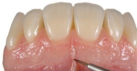 Estetica rosa: come realizzare una gengiva dall'aspetto naturale con composito da laboratorio?