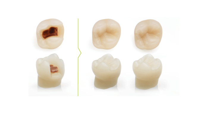 Restorative & prosthetic options for tooth discoloration management