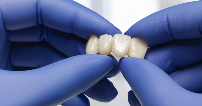 IPS e.max ZirCAD Prime : pourquoi et comment est-il si convaincant ?